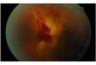 Colour fundus picture of right eye