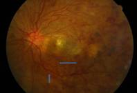 Colour fundus picture of the left eye