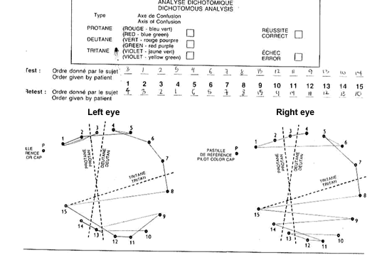 Farnsworth D-15 Hue Test at presentation showing bilateral asymmetrical tritanomaly