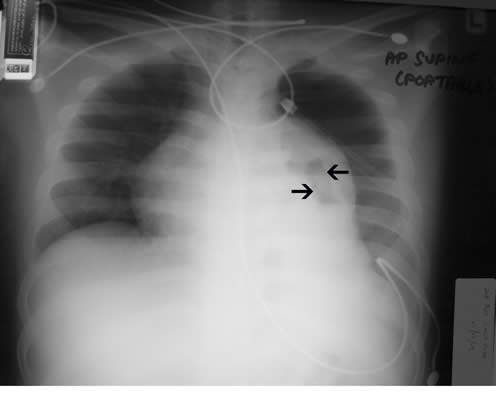Figure 2. Semi-expanded left lung with areas of hyperluscency suggestive of lung parenchymal cavitation (black arrows)