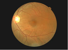 Left Fundus