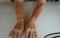Dorsal view of both forearms
