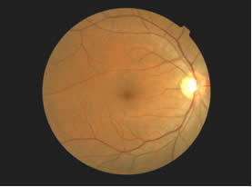 Right Fundus