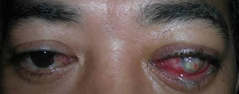 A patient with TED and strabismus of the left eye 