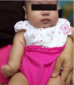 baby with an abnormal upper limb