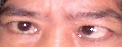 A patient with TED and strabismus of the left eye 