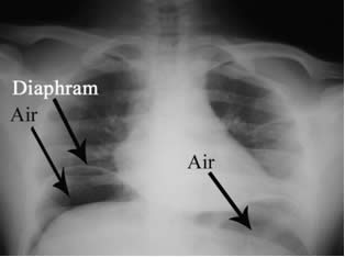 factory worker chest radiograph