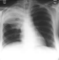 female patient chest radiograph