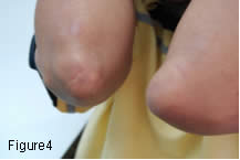 Figure 4 helix of the pinna 