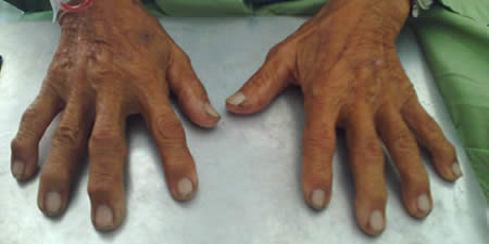 A 62 YEAR OLD MAN WITH PAIN AND STIFFNESS OF HANDS