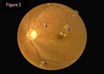 retinal image 2