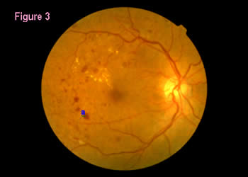 retinal image 3