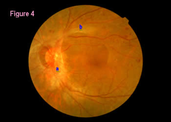 retinal image 4