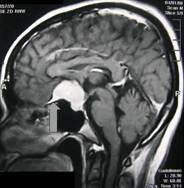 Figure 5: MRI brain 
