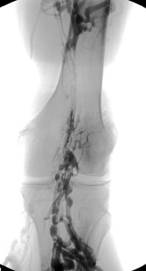 venogram
